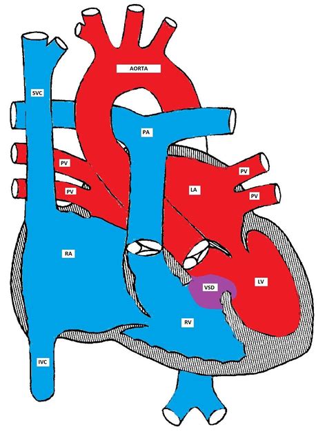 lv shunt|blood shunt in the heart.